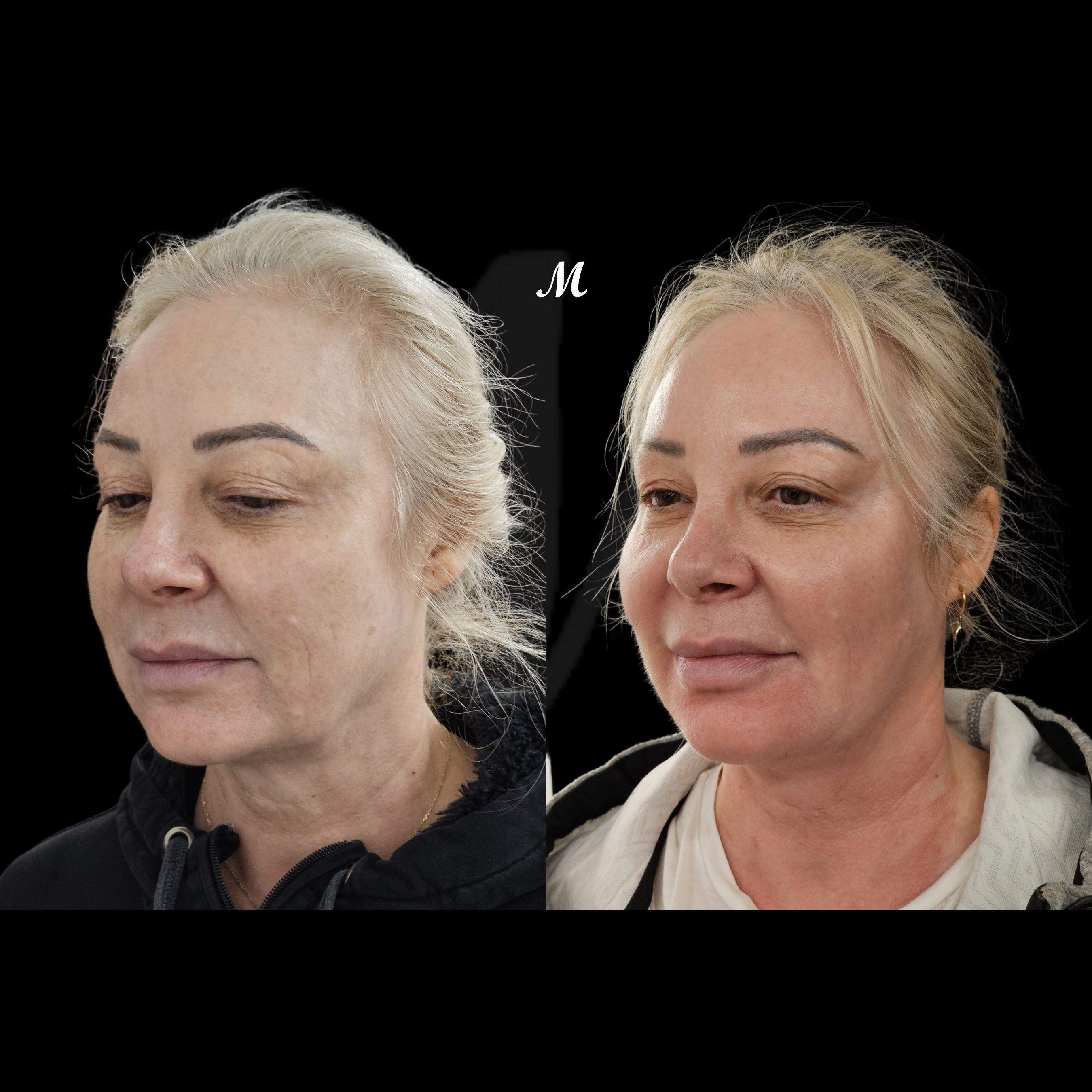 Non-Surgical Facelift